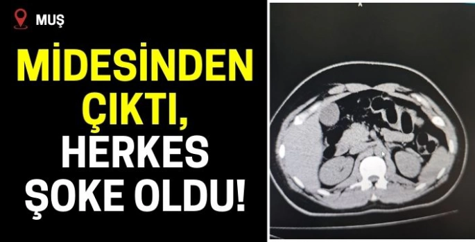 Tüm Muşlular şaşkın! Midesinden çıktı: Herkes şoke oldu!